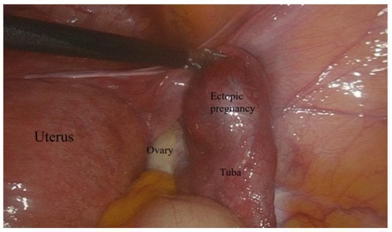 This clinical photograph displays a laparoscopic view of an unruptured ectopic pregnancy within the fallopian tube (tuba). The image highlights the pelvic anatomy, showing the uterus on the left, a partially visible ovary in the center, and the distended fallopian tube on the right. The fallopian tube exhibits significant bulbous swelling and intense erythema, indicating vascular engorgement and inflammation characteristic of an ampullary tubal pregnancy. The tubal surface appears stretched but intact, without visible rupture or active hemorrhage. A laparoscopic surgical instrument is positioned near the affected tube, demonstrating the intraoperative diagnostic and management setting. The educational focus is on the laparoscopic identification of ectopic gestations and the anatomical relationship between the adnexal structures and the uterus in gynecological surgery.