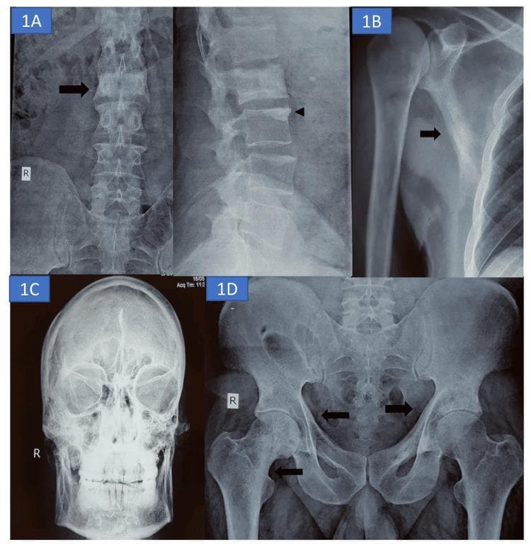 This composite of four conventional radiographs illustrates multi-focal skeletal manifestations of Paget’s disease of bone (PDB). Panel A displays anteroposterior and lateral views of the lumbar spine, highlighting a diffuse sclerosis of the L2 vertebral body, characteristic of an 'ivory vertebra,' with associated coarsened trabeculae and degenerative changes at the L3 endplate. Panel B shows a right shoulder radiograph with prominent cortical thickening along the lateral margin of the scapula. Panel C presents a frontal skull radiograph demonstrating diffuse widening, thickening, and sclerosis of the diploic space, often termed a 'cotton wool' appearance. Panel D is an AP radiograph of the pelvis and proximal femurs, revealing bilateral thickening of the iliopectineal lines (brim sign) and coarsened trabecular patterns within the inferomedial right femoral neck. These findings collectively represent the mixed lytic and sclerotic phases of Paget's disease, focusing on bony expansion and architectural remodeling across the axial and appendicular skeleton.