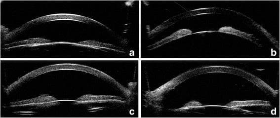 This set of four ultrasound biomicroscopy (UBM) images illustrates the anterior segment of the eyes in a patient with malignant glaucoma and nanophthalmos, before and after treatment. Panel (a) right eye and (b) left eye demonstrate extremely shallow anterior chambers with forward displacement of the iris-lens diaphragm, typical of aqueous misdirection syndrome. Panels (c) and (d) show the same eyes following intervention: the right eye (c) after YAG laser lens posterior capsulotomy and vitreous anterior membranectomy, and the left eye (d) after phacoemulsification combined with vitrectomy and posterior capsulorhexis. In these post-treatment images, there is a visible deepening of the anterior chamber, characterized by an increased distance between the corneal endothelium and the anterior surface of the iris and lens. The images highlight the structural changes in the anterior segment required to resolve ciliary block glaucoma and establish a communication pathway between the vitreous cavity and the anterior chamber.
