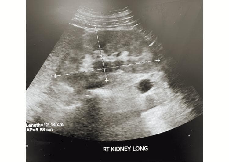 This diagnostic ultrasound image displays a longitudinal view of the right kidney (labeled 'RT KIDNEY LONG'). The renal parenchyma exhibits diffuse, increased echogenicity (hyperechoic appearance), which is a key ultrasonographic sign of parenchymal disease. There is a notable loss of the normal corticomedullary differentiation, as the brightness of the cortex matches or exceeds that of the adjacent liver tissue, often associated with chronic renal disease or acute glomerulonephritis. Two biometry measurements are overlaid on the image: a longitudinal length of 12.14 cm measured pole-to-pole and an anteroposterior (AP) diameter of 5.88 cm taken at the mid-portion. The renal sinus appears relatively echogenic, while the overall morphology suggests underlying pathology such as PR3-ANCA vasculitis or other chronic nephropathies given the clinical context of renal failure and proteinuria. The image serves as an educational example of how ultrasound is used to assess kidney size, echotexture, and structural integrity in a clinical nephrology setting.