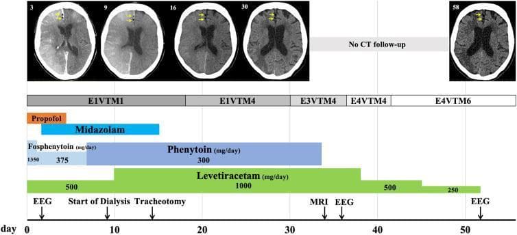 This infographic combines a diagnostic imaging timeline with a clinical management chart for a patient with cerebral arterial gas embolism (CAE). The top section features five axial head CT scans at days 3, 9, 16, 30, and 58. Yellow arrows highlight persistent, small, dark hypodense air pockets in the right frontal lobe/cingulate gyrus, demonstrating prolonged air retention. The lower section includes a timeline (Day 0 to 58) tracking the Glasgow Coma Scale (GCS) scores, which improve from E1VTM1 to E4VTM6. A pharmacological Gantt chart depicts the administration and dosage of sedatives (Propofol, Midazolam) and anticonvulsants (Fosphenytoin, Phenytoin, Levetiracetam). Annotated events include the start of dialysis, tracheotomy, and scheduling of EEG and MRI. This visual resource illustrates the clinical progression, long-term radiographic findings of intracranial air, and intensive seizure management in post-traumatic neurocritical care.