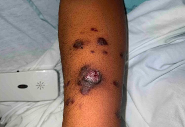 Clinical photograph of the right lower arm demonstrating multiple, multifocal skin lesions characteristic of Kaposi sarcoma (KS). The image shows a spectrum of lesion morphologies, including violaceous to dark-brown papules, plaques, and a prominent exophytic nodule. The central, larger lesion is a raised, pedunculated nodule with a friable, vascular surface and a surrounding hyperpigmented halo. Smaller lesions are scattered proximally and distally, appearing as flat or slightly elevated maculopapular patches with irregular borders. The surrounding skin shows mild edema and post-inflammatory pigmentary changes. This visual is clinically significant for illustrating the classic dermatologic manifestations of human herpesvirus 8 (HHV-8) associated Kaposi sarcoma, frequently seen in the context of immunocompromised states such as advanced HIV/AIDS or Immune Reconstitution Inflammatory Syndrome (IRIS).