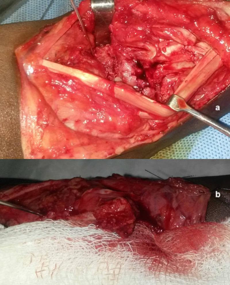 Two-panel clinical photograph displaying intraoperative views of a surgical procedure for scaphoid nonunion with avascular necrosis (AVN). Image (a) shows the dorsoradial wrist incision with the 1,2-intercompartmental supraretinacular artery (1,2-ICSRA) pedicle elevated. A metal retractor exposes the proximal pole of the scaphoid, which appears white and pale, lacking the characteristic 'punctate bleeding' indicative of healthy perfusion, confirming avascular necrosis. Image (b) illustrates the subsequent application of a vascularized bone graft (VBG) harvested from the distal radius. In contrast to the first image, active red punctate bleeding is visible from the graft site, demonstrating successful revascularization and tissue viability. Surgical instruments, including retractors and a needle/suture, are positioned within the field to maintain exposure. The surrounding soft tissues are erythematous and raw, typical of an open surgical field, with white sterile gauze and blue drapes used for fluid management. This clinical sequence highlights a common orthopedic reconstructive technique to treat scaphoid nonunion by providing a biological blood supply to ischemic bone.