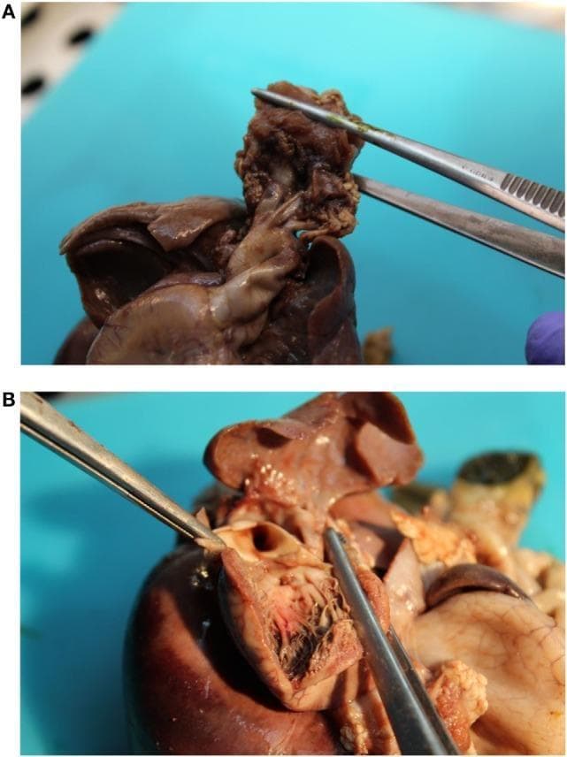 Two-panel gross pathological specimen from a fetal necropsy demonstrating congenital cardiovascular anomalies. Panel (A) shows the external anatomy of the heart and great vessels, highlighting a malpositioned aortic orifice and a distinctive 'S-shaped' curvature of the ascending aorta. Forceps are used to retract tissue, demonstrating that there is no transposition of the great vessels. Panel (B) shows a dissected view of the heart's internal chambers. Metal probes and forceps point to two small, punctate interventricular septal communications (ventricular septal defects): one muscular and one sub-arterial. Visible anatomical features include the interventricular septum, endocardial surfaces, and chordae tendineae. This specimen illustrates complex cardiac malformations often associated with genetic or developmental syndromes, emphasizing anatomical variations in the aortic arch and septal integrity.