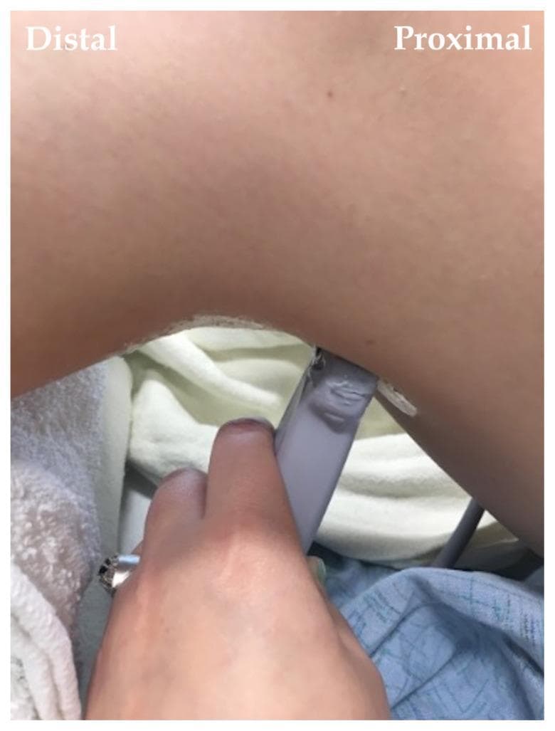 A clinical photograph demonstrating the procedural setup for a regional anesthesia technique, specifically a popliteal fossa block. The image shows a practitioner's hand holding a linear ultrasound probe against the posterior aspect of a patient's leg at the level of the popliteal crease. The probe is positioned transversely to visualize the sciatic nerve and its bifurcation into the tibial and common peroneal nerves. Text overlays indicate the 'Distal' (lower leg) and 'Proximal' (thigh) orientations. Acoustic coupling gel is visible at the interface between the transducer and the skin. This visual serves as a guide for needle-probe coordination and anatomical landmark identification during ultrasound-guided nerve blocks. The patient is in a prone or lateral position, resting on clinical linens, typical of an anesthetic workshop or operative environment.