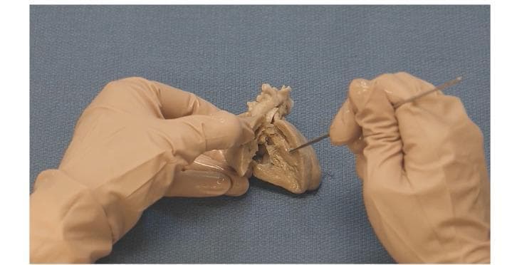 Anatomical Diagram/Clinical Photograph: This image depicts a gross anatomical dissection of a human heart specimen, specifically prepared to demonstrate the pathophysiology of Tetralogy of Fallot (TOF). The cadaveric specimen exhibits a preserved, tan, and fibrous texture, having been bisected to reveal the internal cardiac chambers. Two gloved hands are shown; one stabilizes the specimen while the other utilizes a metal surgical probe to indicate specific structural defects. The educational focus is on visualizing the four key components of TOF: ventricular septal defect (VSD), pulmonary stenosis, right ventricular hypertrophy, and the overriding aorta. The clinical significance of this specimen lies in its use for pediatric cardiology education, providing a three-dimensional perspective on congenital heart disease (CHD) morphology. The image is intended for intermediate to advanced medical learners to understand the spatial relationships between the malaligned interventricular septum and the great vessels.