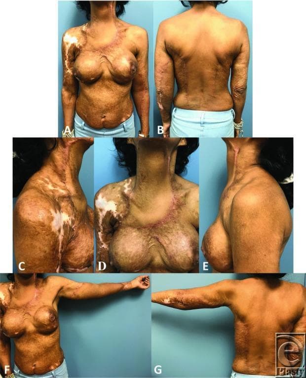 A series of clinical photographs (labeled a–g) documenting a 41-year-old female patient following surgical reconstruction for extensive burn scar contractures. The images show multiple views (anterior, posterior, and lateral) of the neck, chest, upper extremities, and back. Primary visual findings include extensive mottle-patterned burn scars with mixed hyperpigmentation and hypopigmentation, particularly on the right shoulder and chest. Postoperative evidence of latissimus dorsi (LD) flap reconstruction is visible, including surgical incisions and integrated flap tissue on the neck and left upper extremity. Linear surgical scars on the back (posterior view) indicate the donor site where the LD flaps were harvested. The neck views (c, d, e) demonstrate improved range of motion in extension post-reconstruction. The abdomen and breasts show textural changes consistent with prior high-surface-area burn injury. This photographic series serves as an educational resource for plastic and reconstructive surgery, specifically illustrating the use of pre-expanded regional flaps for burn contracture release and secondary reconstruction in adult patients.