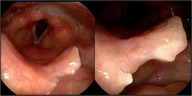 A two-panel clinical endoscopic image featuring a 2-month follow-up flexible laryngoscopy. The left panel provides a wide-angle view of the laryngeal inlet, showing the vocal folds, arytenoids, and epiglottis. The vocal folds appear white, smooth, and in an abducted position, with healthy-appearing surrounding laryngeal mucosa. The right panel displays a close-up view of the epiglottis, revealing a distinct surgical notch on its superior free margin, which is the result of a previous biopsy. The laryngeal surface of the epiglottis and the arytenoid mucosa show a complete resolution of prior granulomatous or ulcerated lesions, now presenting as pink, uniform, and healthy tissue. There are no signs of active inflammation, edema, or polylobulated masses. This image demonstrates the successful response of laryngeal tuberculosis to antitubercular treatment, highlighting the healing of the subepithelial chorion and the restoration of normal laryngeal anatomy and mucosal integrity in an adult patient.