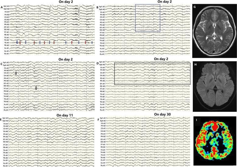 Educational medical composite depicting diagnostic features of anti-NMDAR encephalitis across multiple modalities. Panels A-F show longitudinal electroencephalography (EEG) recordings demonstrating the pathognomonic 'extreme delta brush' (EDB) pattern—characterized by rhythmic delta activity with superimposed fast beta frequency bursts. The EDB evolves from unilateral (Day 2) to bilateral involvement (Day 11) before regressing with treatment (Day 30). Annotations highlight EDB modulation during physiological states: weakening with eyes closed (blue arrows) and sleep stage II, and enhancement during eye-opening (red arrows) and slow-wave sleep. Panels G and H show normal axial T2-weighted and FLAIR MRI scans, emphasizing that structural imaging may be unremarkable in early disease. Panel I presents an Arterial Spin Labeling (ASL) perfusion map showing focal hyperperfusion in the right frontal and temporal regions, correlating with the initial EDB localization. This composite illustrates the critical role of functional neuroimaging and EEG in diagnosing autoimmune encephalitis when structural MRI is negative.