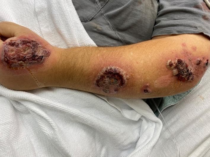 This clinical photograph displays severe dermatological manifestations on the left forearm and hand of a patient, consistent with an acute febrile neutrophilic dermatosis (Sweet syndrome). The primary findings include multiple large, well-demarcated, erythematous plaques and nodules. Significant features of these lesions include central ulceration with dark hemorrhagic crusting and focal areas of necrosis. The borders of the plaques are notably edematous, raised, and intensely inflamed, creating a pseudo-vesicular or succulent appearance characteristic of neutrophilic infiltration. Smaller, discrete erythematous papules and patches are scattered proximally along the forearm. Widespread diffuse erythema and apparent soft tissue edema are visible in the surrounding skin, with some adjacent areas showing post-inflammatory hypopigmentation. The distribution involves the dorsal hand, wrist, and extensors of the forearm, representing a common clinical presentation for this condition. This image serves as an educational example of the bullous or ulcerative variant of Sweet syndrome, highlighting the importance of distinguishing these lesions from infectious processes like cellulitis or necrotizing fasciitis.