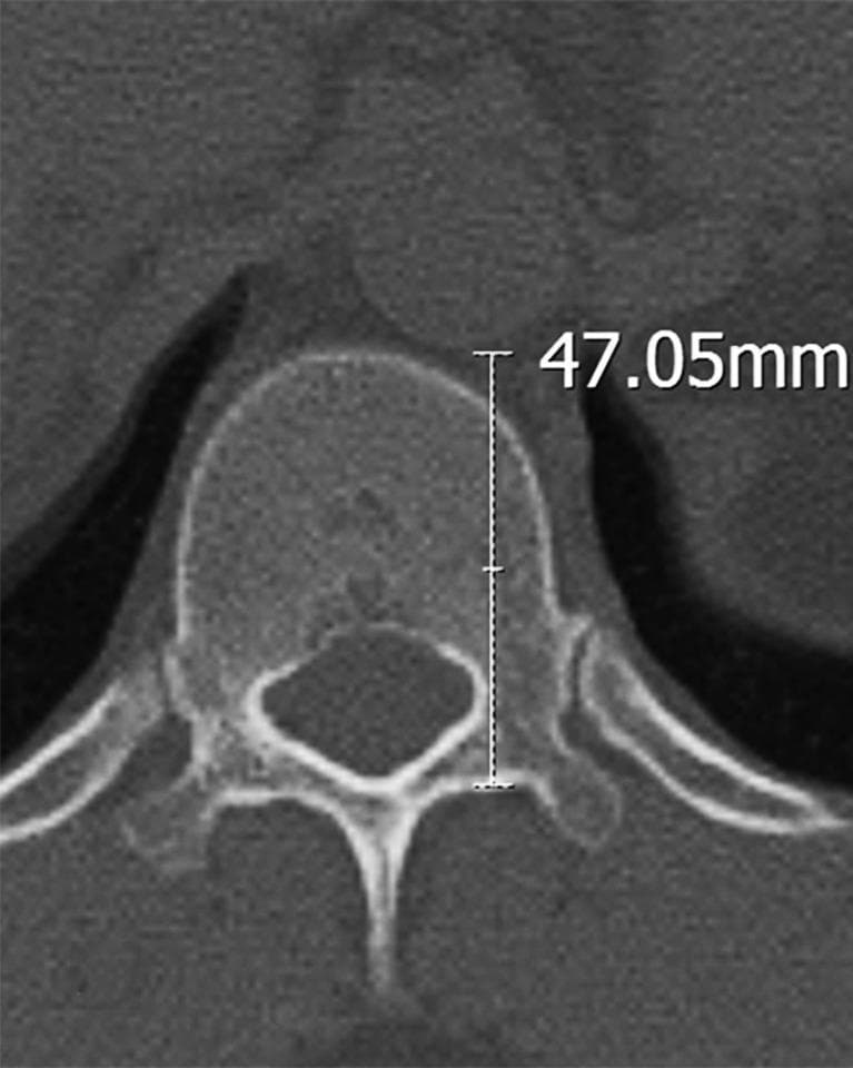 This diagnostic axial CT scan image shows a transverse section of a human vertebra, specifically identified as the T12 level. The bony anatomy includes the rounded vertebral body, the central spinal canal, bilateral pedicles, and a posterior spinous process. A digital linear measurement is overlaid on the image, showing a value of 47.05mm. This caliper measurement calculates the distance between the anterior margin of the vertebral body and the posterior wall of the spinal canal (lamina). The image demonstrates clinical morphometric analysis used in preoperative planning for spinal surgery, such as assessing pedicle screw trajectory and length relative to surrounding neurovascular structures like the thoracic aorta. The scan provides high-contrast detail of the cortical and cancellous bone density, typical of bone-window CT imaging for musculoskeletal assessment.