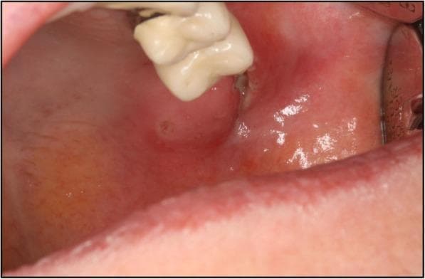 This clinical photograph is an intraoral image showing the upper left maxillary region of a 67-year-old patient. The visual focus is on the soft tissue surrounding a wisdom tooth (third molar). The gingiva and adjacent buccal mucosa exhibit pronounced erythema and edema, indicating acute inflammation. A significant feature is a localized soft tissue laceration or ulcerative lesion situated immediately distal and lateral to the tooth, with an irregular border and a central depression. The tooth appears partially erupted or impacted within the swollen gingival tissue. Clinical context suggests these findings are the primary intraoral manifestation of tularemia, associated with severe systemic symptoms like high fever and elevated C-reactive protein. This image serves as a clinical example of atypical oral infections and the importance of correlating local lesions with systemic inflammatory markers in oral surgery and infectious disease diagnostics.