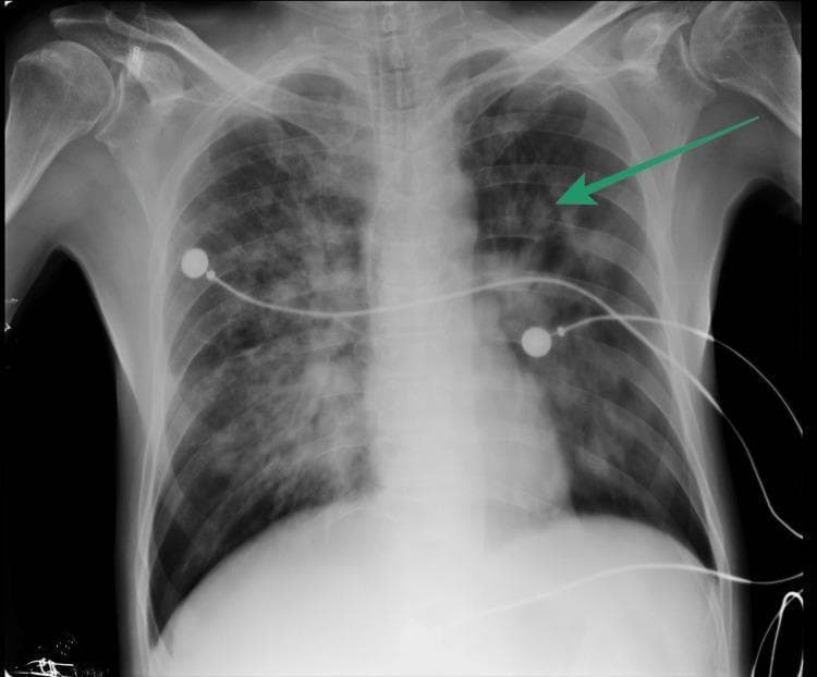 This diagnostic image is an anteroposterior (AP) chest X-ray demonstrating significant pulmonary pathology. The primary finding is a large, well-defined cavitary lesion in the left upper lobe, indicated by a green arrow, which shows increased lucency surrounded by thick, heterogeneous walls. Both lung fields exhibit diffuse, bilateral patchy opacities and infiltrates, more pronounced in the mid and upper zones, suggesting extensive consolidation or inflammatory process consistent with active pulmonary tuberculosis. Extrathoracic structures include radiopaque medical instrumentation: several ECG leads and circular electrode pads are superimposed across the chest cavity. The cardiomediastinal silhouette appears within normal limits for an AP view, though partially obscured by overlying pulmonary pathology. Skeletal structures, including the ribs, clavicles, and humeral heads, are visible. This radiographic presentation is highly characteristic of mycobacterial infection with cavitary disease, serving as a critical educational example of secondary tuberculosis findings in an adult patient.