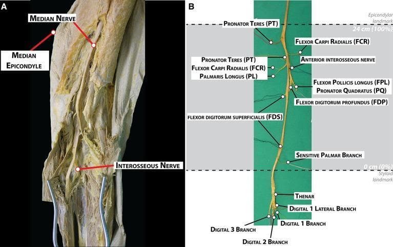 This educational image displays the gross anatomy and morphological branching pattern of the human median nerve through dissection. Image A is a clinical photograph showing the median nerve in situ within the medial aspect of the arm and elbow, with the median epicondyle and interosseous nerve labeled as landmarks. Image B presents the fully harvested median nerve against a green background, detailing its extensive branching hierarchy. Muscular branches are identified proximally to distally, including the pronator teres (PT), flexor carpi radialis (FCR), palmaris longus (PL), anterior interosseous nerve, flexor pollicis longus (FPL), pronator quadratus (PQ), flexor digitorum profundus (FDP), and flexor digitorum superficialis (FDS). Distal terminal branches are shown extending into the hand, including the sensitive palmar branch, thenar branches, and digital branches (1-3). The diagram includes a normalized distance scale, designating the epicondylar landmark at 24 cm (100%) and the styloid landmark at 0 cm (0%). This visual serves as a topographical guide for identifying nerve distribution during surgical procedures like electrode implantation or neurolysis.