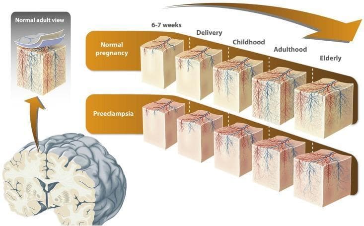 This medical illustration presents a comparative pathophysiology diagram showing cortical microvascular development across the human lifespan in offspring from normal pregnancies versus those affected by preeclampsia. The central visualization consists of two parallel rows of cubic cortical tissue segments spanning five life stages: 6-7 weeks fetal development, delivery, childhood, adulthood, and the elderly. In the 'Normal Pregnancy' row, there is a progressive increase in the density and complexity of the microvascular network (depicted as red arterial and blue venous vessels) reaching its peak in adulthood, followed by a decline in the elderly stage. The 'Preeclampsia' row illustrates reduced angiogenesis and a lower density of microvessels at every corresponding stage compared to the normal group. An inset titled 'Normal Adult View' highlights the anatomical layers, including the pial lamella and the pial capillary anastomotic plexus, showing how the cortical microvasculature originates from this surface plexus. An anatomical diagram of a whole brain in coronal section identifies the cortical region represented in the cubes. The infographic serves to explain how maternal preeclampsia may cause life-long alterations in brain vascular architecture, potentially impacting cognitive health.