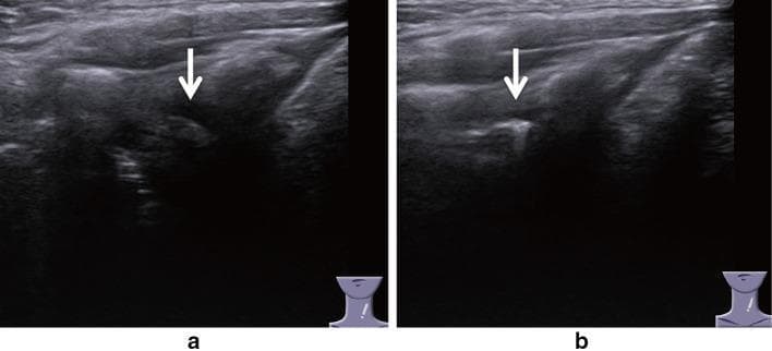 Side-by-side diagnostic ultrasound images demonstrating the laryngeal anatomy using a lateral vertical procedure. The images specifically focus on the visualization of the muscular process (MP) of the arytenoid cartilage to assess vocal cord dynamics. Panel (a) shows the larynx during abduction; at the white arrow, the muscular process is not visible as it has rotated out of the imaging plane. Panel (b) shows the larynx during adduction; the white arrow points to a distinct, hyperechoic structure representing the visible muscular process of the arytenoid cartilage. Surrounding soft tissue structures include the thyroarytenoid and lateral cricoarytenoid muscles. This imaging technique is utilized in otolaryngology to evaluate vocal cord movement and diagnose conditions such as vocal cord paresis or paralysis by observing the presence or absence of rhythmic arytenoid cartilage displacement. The lateral approach bypasses laryngeal air interference and thyroid cartilage calcification common in traditional transverse views.