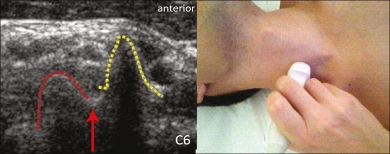 This composite figure features a clinical photograph of a neck ultrasound examination alongside the resulting diagnostic ultrasound image of the C6 cervical nerve root and its related skeletal landmarks. The ultrasound image (left) uses a transverse plane to demonstrate the characteristic morphology of the C6 transverse process. The anterior tubercle is outlined with a yellow dotted line, appearing as a prominent peak-like hyperechoic structure. The posterior tubercle is outlined with a red dotted line, presenting as a rounded hyperechoic prominence. A solid red arrow identifies the C6 nerve root, which appears as a round hypoechoic (dark) structure resting in the groove between the anterior and posterior tubercles (the 'intertubercular sulcus'). This specific anatomical configuration, where the two tubercles are of similar height, is a key diagnostic landmark for identifying the C6 level during regional anesthesia or cervical nerve blocks. The clinical photograph (right) shows the transducer placement on the lateral aspect of the neck to obtain this view.