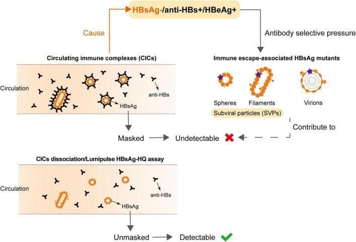 This pathophysiology diagram illustrates the mechanisms underlying undetectable Hepatitis B surface antigen (HBsAg) in patients who are HBeAg-positive and anti-HBs-positive. The diagram is divided into two primary pathways: the formation of Circulating Immune Complexes (CICs) and the emergence of HBsAg mutants. In the CIC pathway, HBsAg particles are shown in circulation bound by Y-shaped anti-HBs antibodies; this 'masking' of epitopes renders the antigen undetectable by standard assays. A lower panel demonstrates that chemical dissociation or specialized assays (e.g., Lumipulse HBsAg-HQ) can unmask these antigens, making them detectable. The second pathway shows 'Immune escape-associated HBsAg mutants' arising from antibody selective pressure. These are depicted as spheres, filaments (together termed subviral particles or SVPs), and complete virions with altered surface epitopes (marked by purple stars). Both CIC formation and mutant emergence contribute to the diagnostic challenge of occult Hepatitis B infection (OBI). This diagram is intended for intermediate to advanced medical education regarding HBV serology, diagnostic pitfalls, and immune escape mechanisms.