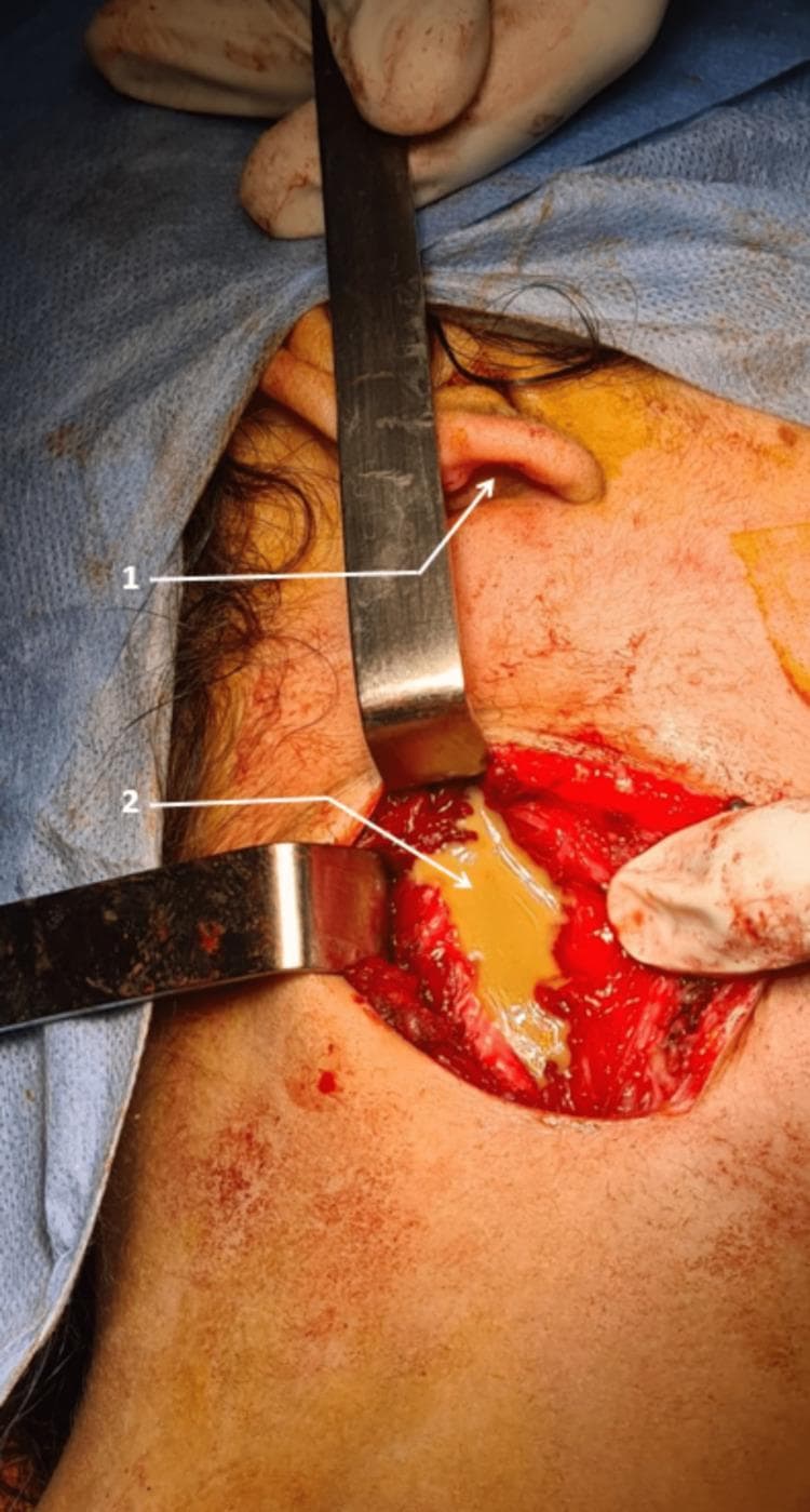 This clinical photograph captures an intra-operative view of a surgical site in the cervical region, positioned near the earlobe (marked as '1'). The image demonstrates the drainage of a 'cold abscess' secondary to lymph node tuberculosis. Two metallic hand-held retractors are used to provide surgical exposure, revealing a deep tissue cavity. Within this cavity, there is a prominent collection of yellowish, viscous, purulent material (pus, marked as '2'), which is characteristic of the caseous necrosis and liquefaction seen in tuberculous lymphadenitis. The surrounding soft tissues show an erythematous, inflammatory appearance with localized bleeding. The surgical field is prepared with antiseptic solution, and sterile drapes are visible. This visual serves as an educational example of the surgical management of cervical lymph node tuberculosis, specifically the intra-operative presentation of abscess formation and the mechanical drainage required for therapeutic management in advanced presentations of the disease.