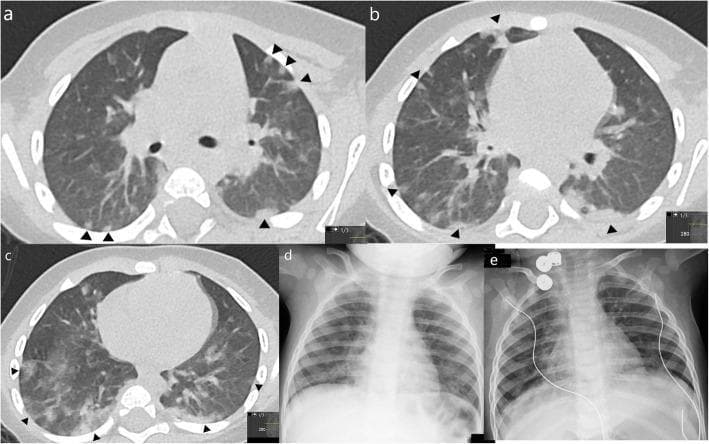 This composite figure presents diagnostic imaging findings in a 10-month-old infant with confirmed COVID-19. Panels (a-c) are axial non-contrast chest CT slices demonstrating patchy consolidations and ground-glass opacities (GGO) with a characteristic subpleural and peripheral distribution throughout the upper and lower lobes. Black arrowheads highlight the 'halo sign,' where central areas of consolidation are surrounded by peripheral rings of ground-glass opacity. Panels (d) and (e) show a longitudinal comparison of chest X-rays. Image (d), taken one day prior to the CT, shows subtle, diffuse bilateral pulmonary opacities. Image (e), performed four days after the initial X-ray, illustrates a partial resolution of these bilateral opacities, indicating clinical improvement. This series highlights the classic pediatric radiological presentation of SARS-CoV-2 infection, emphasizing peripheral lung involvement and the evolution of findings over a short clinical course.