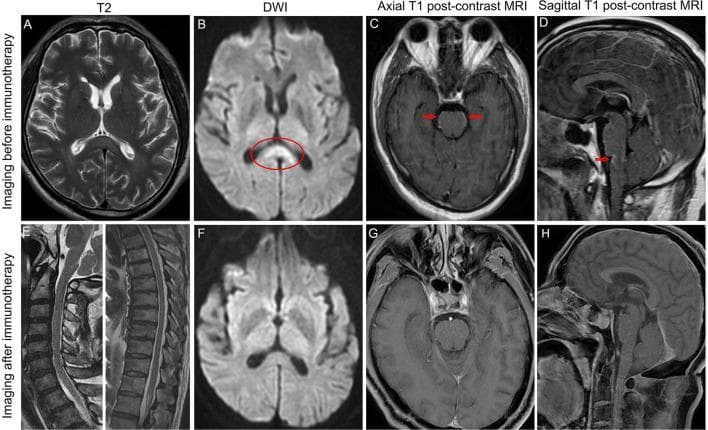 This composite of magnetic resonance imaging (MRI) scans demonstrates a case of autoimmune encephalitis (specifically anti-GFAP astrocytopathy) before and after immunotherapy. The top row (A-D) shows pre-treatment findings: (A) axial T2-weighted and (B) diffusion-weighted imaging (DWI) reveal hyperintensity in the splenium of the corpus callosum (red oval). (C) Axial and (D) sagittal post-contrast T1-weighted sequences show linear leptomeningeal enhancement along the ventral surface of the pons and medulla (red arrows). Panel (E) presents a sagittal T2-weighted view of the cervical and thoracic spinal cord showing normal signal intensity. The bottom row (F-H) illustrates the treatment response post-immunotherapy: (F) axial DWI shows complete resolution of the corpus callosum hyperintensity, and (G, H) axial and sagittal post-contrast T1-weighted sequences show the disappearance of the previously noted leptomeningeal enhancement in the brainstem. This image serves as a clinical comparison of inflammatory central nervous system changes and their radiological resolution following targeted immunosuppressive therapy.