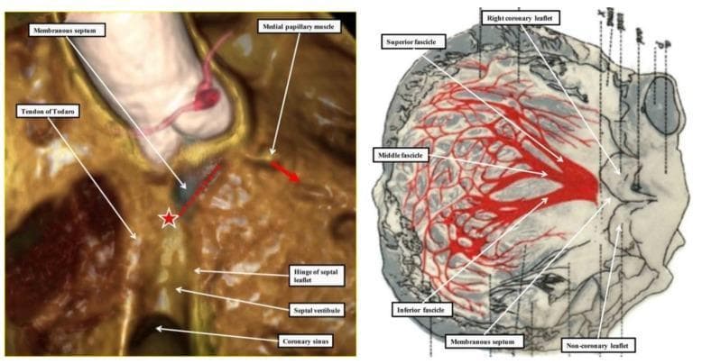 This dual-panel image compares modern 3D clinical imaging with historical anatomical illustrations to demonstrate the atrioventricular (AV) conduction system. The left panel is a 3D-reconstructed CT image of the right atrium and ventricular septal surface. Key landmarks of the triangle of Koch are labeled, including the tendon of Todaro, the coronary sinus, and the hinge of the septal leaflet of the tricuspid valve. A red star marks the location of the AV node, while a red dotted line traces the conduction axis along the muscular ventricular septal crest. A red arrow indicates the emergence of the right bundle branch near the medial papillary muscle. The right panel is a historical illustration by Tawara, showing the left ventricular septal surface. It highlights the trifascicular distribution of the left bundle branch, specifically labeling the superior fascicle (extending toward the supero-lateral papillary muscle), the inferior fascicle (extending toward the infero-septal muscle), and the middle fascicle forming a mesh-like network.