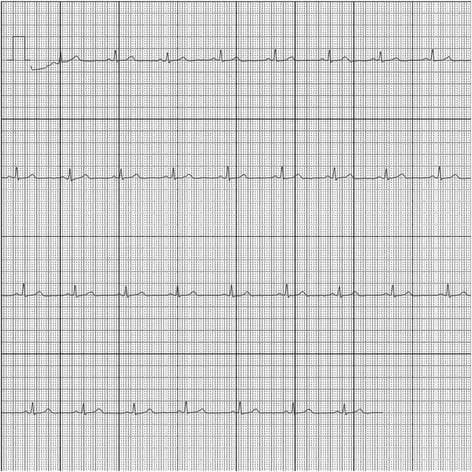 This diagnostic image shows a single-lead electrocardiogram (ECG) tracing recorded on a standard grid, representative of mobile health monitoring (e.g., AliveCor/Kardia). The rhythm displayed is a normal sinus rhythm. The tracing consists of four continuous lines of cardiac cycles, characterized by regular R-R intervals. Each complex demonstrates a clearly visible P wave preceding every QRS complex, followed by a rounded T wave, indicating normal electrical conduction from the sinoatrial node. The QRS complexes are narrow and uniform in morphology. A calibration signal (a tall, rectangular waveform representing 1mV amplitude) is present at the beginning of the first line. The background grid consists of small 1mm squares and larger 5mm squares (defined by thicker lines), used for calculating heart rate (bpm) and interval durations (milliseconds). This visual is used in clinical education to demonstrate normal cardiac electrical activity and the output format of handheld ECG devices compared to traditional 12-lead systems.