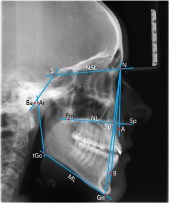 This diagnostic image is a lateral cephalogram, a specialized orthodontic X-ray of the human skull in profile. It features an overlay of blue geometric lines and red landmark points used for cephalometric analysis. Key anatomical landmarks identified include Sella (S), Nasion (N), A-point (A), B-point (B), Gnathion (Gn), Gonion (Go), and Articulare (Ar). The image illustrates several diagnostic variables: the SNA, SNB, and ANB angles for assessing the sagittal relationship of the maxilla and mandible relative to the cranial base; the NSBa angle for cranial base flexure; and the ML-NSL, NL-NSL, and ML-NL angles for evaluating vertical growth patterns and the inclination of the nasal and mandibular planes. The radiograph clearly shows the skeletal structures of the cranium, facial bones, dentition, and upper cervical vertebrae. This material is primarily used in orthodontics and maxillofacial surgery for treatment planning and growth monitoring.