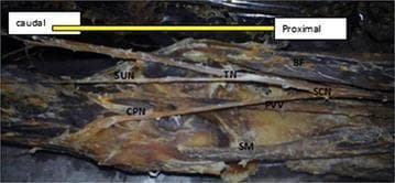 This clinical photograph displays a detailed cadaveric dissection of the left popliteal fossa, highlighting the anatomical variations in the branching of the sciatic nerve (SCN). The SCN is shown dividing in the distal thigh into its two primary branches: the tibial nerve (TN) and the common peroneal nerve (CPN). The tibial nerve maintains a more medial, vertical course alongside the popliteal vessel (PVV), while the common peroneal nerve deviates laterally toward the fibular head. Notably, the sural nerve (SUN) is seen originating from the tibial nerve within the fossa. The neurovascular structures are framed by the posterior thigh musculature: the biceps femoris (BF) forms the lateral border, and the semimembranosus (SM) and semitendinosus (ST) muscles form the medial border. This image serves as an educational reference for understanding the spatial relationships of the popliteal contents and common anatomical variations in sciatic nerve bifurcation levels and sural nerve origin, critical for surgical planning and regional anesthesia.