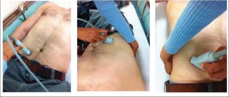 A series of three clinical photographs demonstrating the 'graded compression' technique for point-of-care ultrasound (POCUS) of the appendix. The images show a medical practitioner applying a high-frequency linear transducer to the patient's right lower quadrant (RLQ). The probe is oriented in transverse and oblique planes over McBurney's point to identify the vermiform appendix. Visually evident is the practitioner's use of their non-scanning hand to provide complementary steady pressure on the abdominal wall. This manual compression is an essential clinical maneuver designed to displace overlying bowel gas, reduce the distance between the abdominal wall and the retrocecal or pelvic structures, and assess the compressibility of the appendix. The target audience for this procedural imagery includes emergency physicians and radiologists learning to diagnose acute appendicitis through ultrasonographic findings such as increased appendiceal diameter (>6mm) or non-compressibility.