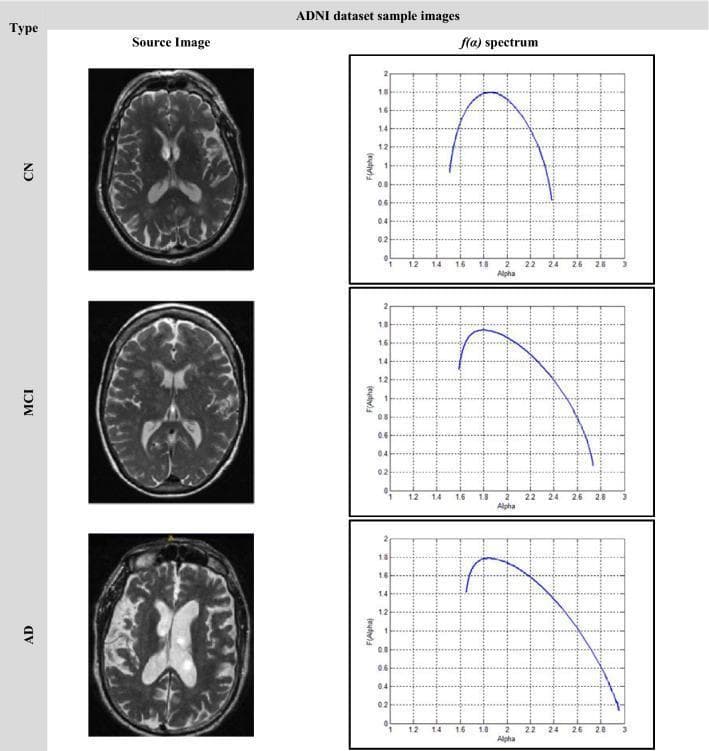 This infographic illustrates the neuroanatomical and multifractal changes across three stages of cognitive decline in the ADNI dataset: Cognitively Normal (CN), Mild Cognitive Impairment (MCI), and Alzheimer's Disease (AD). The visual is organized into a matrix comparing T2-weighted axial brain MRI slices (Source Image) with their corresponding singularity spectrum plots (f(α) spectrum).
Clinical Imaging Findings:
- CN: Shows normal brain volume with well-defined sulci and standard ventricular size.
- MCI: Exhibits subtle cortical atrophy and mild ventricular enlargement.
- AD: Demonstrates significant global cerebral atrophy, marked widening of the sulci, and pronounced ventriculomegaly, indicating substantial loss of brain tissue and increased cerebrospinal fluid (CSF) volume.
Multifractal Analysis:
The f(α) spectrum plots quantify structural complexity. As the disease progresses from CN to AD, the curves shift to the right (higher Alpha values) and become significantly broader. This widening indicates increased structural heterogeneity and irregularity within the brain tissue, serving as a mathematical signature for the pathological progression of Alzheimer's dementia.