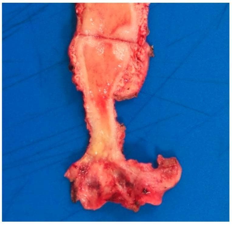 This clinical photograph displays a gross surgical specimen of the uterus, cervix, and upper vagina following a total hysterectomy. The cervix exhibits a prominent, pathological yellowish lesion that is indurated and demonstrates poorly defined, infiltrative margins. This discoloration significantly contrasts with the surrounding healthy pinkish-red cervical tissue. The lesion involves the entirety of the uterine cervix and extends focally into the upper vaginal mucosa. The surface texture of the affected area appears irregular and distorted, suggesting a chronic inflammatory or neoplastic process. Clinically, such presentations can mimic cervical carcinoma, although this specific specimen relates to malakoplakia, a rare chronic granulomatous condition. The image is an essential educational tool for understanding gross pathological manifestations in the female reproductive tract, emphasizing the importance of histological confirmation when distinguishing between infectious/inflammatory masses and malignancy.