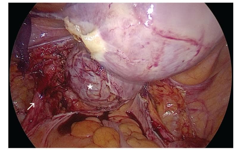 This intraoperative laparoscopic photograph provides a view of the pelvic cavity during a gynecological surgical procedure. The primary focus is a large, well-defined cervical cyst, marked with a white star, located in the posterior left lateral wall of the cervix. The cyst appears as a rounded, subserosal mass with a slightly irregular, lobulated surface and prominent superficial vascular markings. The sheer size of the cyst causes visible displacement of the cervix to the right lateral anterior side. An arrow points to the left ureter, which is identified in the retroperitoneal space following the dissection of the posterior leaf of the broad ligament and the uterosacral ligament. The ureter appears as a thin, tubular structure in close proximity to the cyst wall, emphasizing the risk of secondary ureteral compression and hydroureter in cases of large cervical masses like Nabothian cysts or cervical adenomyosis. The surrounding surgical field shows the uterus, pelvic peritoneum, and initial stages of tissue dissection required for a laparoscopic hysterectomy.