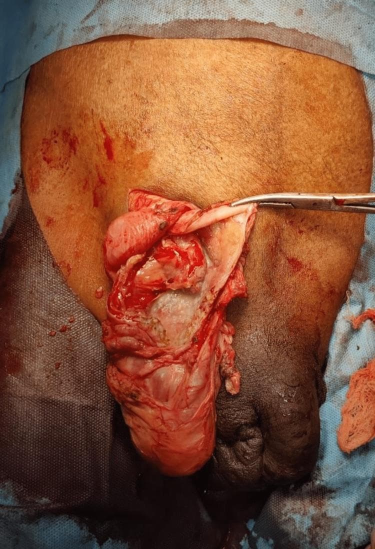 This clinical photograph captures an intraoperative view of an Amyand's hernia repair in a 47-year-old male. The surgical field focuses on the right inguinal region, where an incision has been made to expose the inguinal canal. A surgical hemostat or forceps is seen retracting a thin, membranous hernial sac. Protruding through the inguinal defect and within the sac is a clearly visible, elongated, and hyperemic (reddened) vermiform appendix, indicating inflammation (acute appendicitis). The surrounding tissue shows signs of surgical dissection, including minor hemorrhage and the presence of moist, glistening serosa. Anatomically, the base of the scrotum is visible below the surgical site, and the surrounding skin is prepped for a sterile procedure. This image is of high educational value for demonstrating a rare clinical entity where the appendix is found within an inguinal hernia sac, necessitating both appendectomy and hernia repair (modified Bassini's repair in this case).