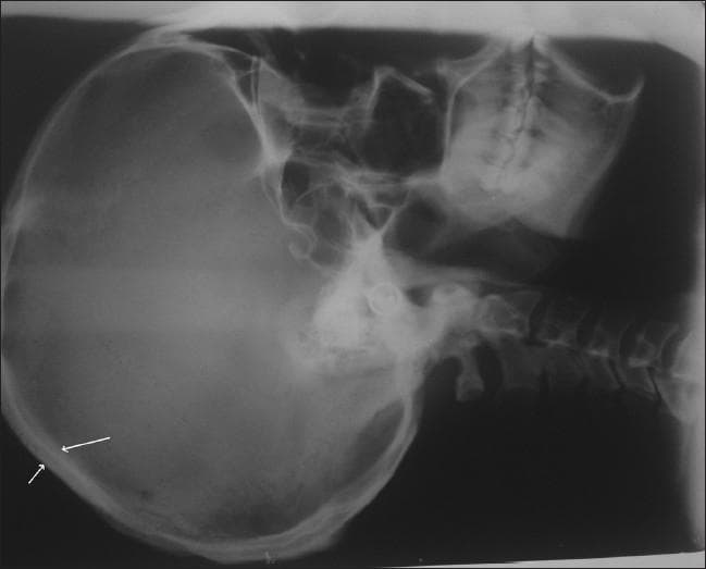 This diagnostic image is a lateral skull radiograph (X-ray) demonstrating significant skeletal manifestations often associated with chronic fluoride toxicity (skeletal fluorosis) or metabolic bone disorders. The image reveals marked thickening and increased radiopacity (sclerosis) of both the inner and outer tables of the skull. White arrows indicate areas of cortical thickening and expansion of the diploic space. There is a visible loss of the normal sharp demarcation between the tables and the intervening diploe, creating a blurred, dense bony architecture. Additional findings include prominent marrow spaces and altered density within the cervical vertebrae and mandibular structures. This visual represents a classic clinical example used to teach the radiological signs of generalized osteosclerosis and the structural bone changes resulting from prolonged ingestion of high fluoride levels. The image is relevant for medical students and radiology residents studying metabolic bone diseases and toxicology.
