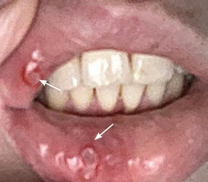 This clinical photograph shows the labial mucosa of the upper and lower lips, demonstrating characteristic signs of primary herpetic gingivostomatitis. The image reveals multiple, discrete and coalescing vesicles and small, shallow ulcers. On the upper labial mucosa near the oral commissure, a cluster of small, whitish lesions is visible, marked by an arrow. On the lower lip, similar lesions are present, with some areas showing coalescence into larger, irregular ulcerations with yellowish-white fibrinopurulent bases. All lesions are surrounded by a distinct erythematous halo, indicating acute inflammation. The presentation is typical for an initial infection with Herpes Simplex Virus (HSV), illustrating the transition from vesicles to painful ulcerations on non-keratinized oral mucosa. This visual is suitable for dental and medical education regarding viral orofacial infections and differential diagnosis of vesiculobullous diseases.