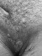 This clinical photograph, presented in grayscale, captures the genital and pubic region of a patient exhibiting a dense eruption of skin lesions. The primary morphology consists of multiple well-demarcated, dome-shaped papules and pustules. A defining characteristic of these lesions is umbilication, where each lesion features a distinct central depression or pit. The lesions are distributed widely across the hair-bearing and adjacent skin areas, appearing both in discrete forms and as clusters. While the grayscale rendering limits color assessment, there is no evidence of gross surrounding tissue necrosis or extensive cellulitis in the visible field. This presentation is highly characteristic of viral dermatological infections, specifically such as Molluscum Contagiosum or infections caused by certain Orthopoxviruses (e.g., Mpox/Monkeypox virus), emphasizing the educational focus on identifying umbilicated genital lesions within the context of sexually transmitted infections (STIs) and public health diagnostic pathways.