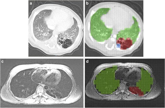 This composite figure demonstrates diagnostic imaging and quantitative analysis of a Congenital Pulmonary Airway Malformation (CPAM) in the left lower lobe. Panel (a) is an axial postnatal CT scan showing a localized, multicystic air-filled lesion with thin internal septations and low attenuation, characteristic of a cystic congenital lung abnormality. Panel (c) provides an axial school-age MRI of the same patient, displaying the lesion's evolution with mixed signal intensity in the left posterior lung field. Panels (b) and (d) illustrate specialized volumetric scoring methods: CLAQ (Congenital Lung Abnormalities Quantification on CT) and CLAM (on MRI), respectively. These panels use color-coded grid overlays to differentiate tissue types: green indicates normal lung parenchyma, red identifies the primary CPAM lesion, and blue highlights lesion-associated abnormalities such as atelectasis. This comparison highlights the utility of multi-modal imaging in the longitudinal follow-up of pediatric congenital lung lesions from infancy to school age.