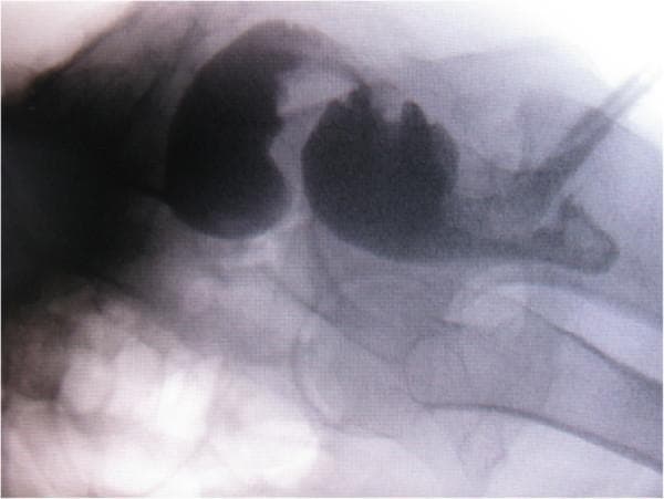 This lateral proctography image (defecography) demonstrates a contrast-filled rectum and anal canal. The radiopaque contrast medium highlights the internal morphology of the pelvic floor, revealing a significant anterior outpouching of the rectal wall consistent with a rectocele. The rectal lumen appears distended, with visible irregularities in the mucosal contour and a narrowing distal to the rectocele. An opacified catheter is visible, likely used for contrast administration. Surrounding anatomical landmarks include the bony pelvis, specifically the sacrum, coccyx, and pubic symphysis, which are visible as high-density structures providing spatial orientation. Clinically, this imaging modality is used to evaluate pelvic floor dysfunction, including obstructed defecation syndrome, rectal prolapse, and the anatomical relationship between the rectum and the vaginal wall during straining. The presence of the large rectocele and luminal narrowing provides visual evidence for mechanical causes of chronic constipation and difficult bowel movements.