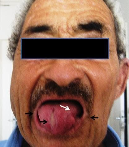 Clinical photograph of a 62-year-old male presenting with orofacial manifestations of Chorea-acanthocytosis (ChAc). The image highlights oromandibular dystonia and its chronic sequelae. A white arrow points to the tongue, which exhibits significant dystonic posturing and shape distortion. Black arrows indicate the sequelae of recurrent self-mutilation, including deep lacerations, irregular tissue loss, and chronic scarring along the lateral borders of the tongue and the commissures of the lips. The oral cavity shows evidence of repeated biting injuries, a characteristic clinical finding in neuroacanthocytosis syndromes. These findings are pedagogically significant for identifying movement-disorder-related self-mutilation, which distinguishes ChAc from other choreiform disorders. The photo is taken post-treatment for facial cellulitis, though the underlying neurological and mechanical tissue damage remains visible.