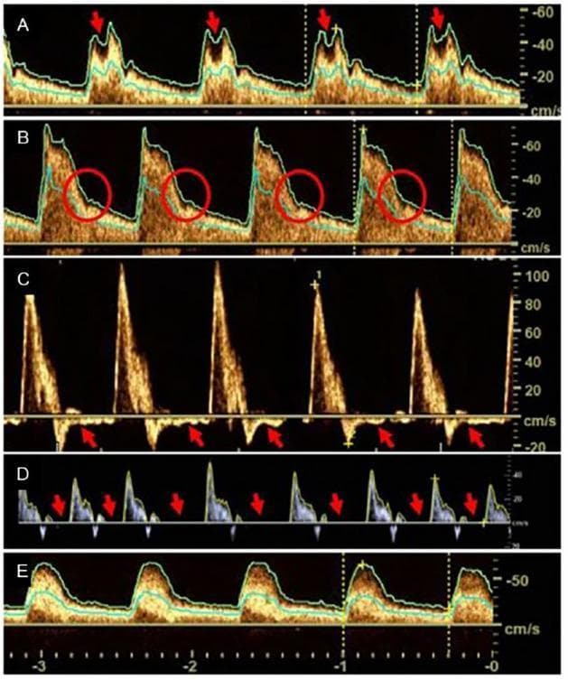 This diagnostic image set consists of five neurovascular ultrasound (nvUS) spectral Doppler waveforms (Panels A–E) illustrating pathological flow profiles in the carotid arteries associated with aortic valve disease. Panel A displays a 'bisferious pulse' (pulsus bisferiens) in the internal carotid artery (ICA), characterized by two systolic peaks marked by red arrows. Panel B shows the ICA with an absent dicrotic notch, indicated by red circles during the early diastolic phase. Panel C demonstrates 'diastolic reversal' in the common carotid artery (CCA), with red arrows highlighting retrograde flow below the baseline during diastole, a classic sign of severe aortic regurgitation. Panel D shows 'zero diastole,' where diastolic flow velocity reaches the baseline (red arrows), indicating high resistance or significant valvular pathology. Panel E illustrates 'pulsus tardus et parvus' in the ICA, characterized by a prolonged systolic upstroke (tardus) and low peak systolic velocity (parvus), typically indicative of aortic valve stenosis. These Doppler waveforms serve as clinical markers for secondary hemodynamic effects of valvular heart disease on cerebral perfusion.