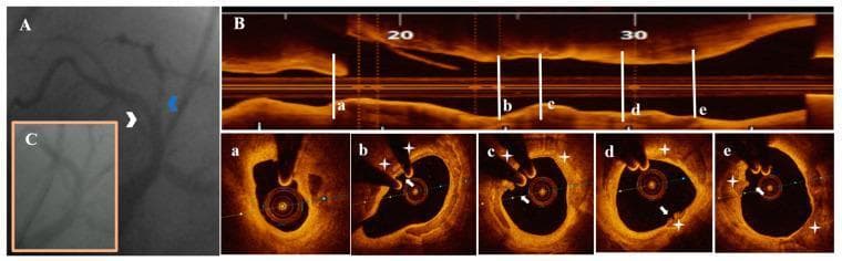 This composite figure illustrates diagnostic and therapeutic findings in a 74-year-old patient with unstable angina pectoris (UAP). Panel A is a coronary angiogram (CA) demonstrating multi-vessel involvement: a white arrowhead identifies borderline stenosis in the proximal left anterior descending (LAD) artery, and a blue arrowhead indicates significant stenosis in the proximal second diagonal branch. Panel B provides high-resolution optical coherence tomography (OCT) imaging of the LAD. The longitudinal top view shows the plaque extent, while cross-sections (a-e) reveal detailed morphology. Specifically, sections b through e highlight speckled echolucent plaque (SCP) consistent with plaque erosion (PE), characterized by an irregular lumen surface and white thrombi (white arrows) attached to the vessel wall. Section (a) quantifies severe area stenosis at 73.9%. Panel C shows the post-interventional CA result following percutaneous coronary intervention (PCI) with a 2.75 mm drug-eluting stent in the LAD and balloon angioplasty in the second diagonal branch, showing restored luminal patency.