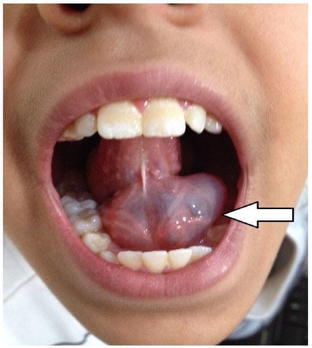 Clinical photograph of a pediatric patient's oral cavity showing a simple ranula. The image displays a large, well-circumscribed sublingual mass located on the floor of the mouth, originating from the base of the tongue near the midline. The mass is characterized by a distinctive translucent, bluish hue, indicative of an underlying mucocele or fluid collection, specifically a mucous extravasation cyst arising from the sublingual gland. The overlying mucosa appears thin but otherwise intact and non-inflamed. The tongue is visibly elevated and displaced superiorly by the cyst's volume. A white arrow points to the lateral aspect of the lesion, highlighting its tense, cystic morphology and significant size relative to the oral space. This visual serves as a classic diagnostic example of a ranula in an adolescent, illustrating the hallmark physical findings that differentiate sublingual cystic lesions from other floor-of-the-mouth pathologies.
