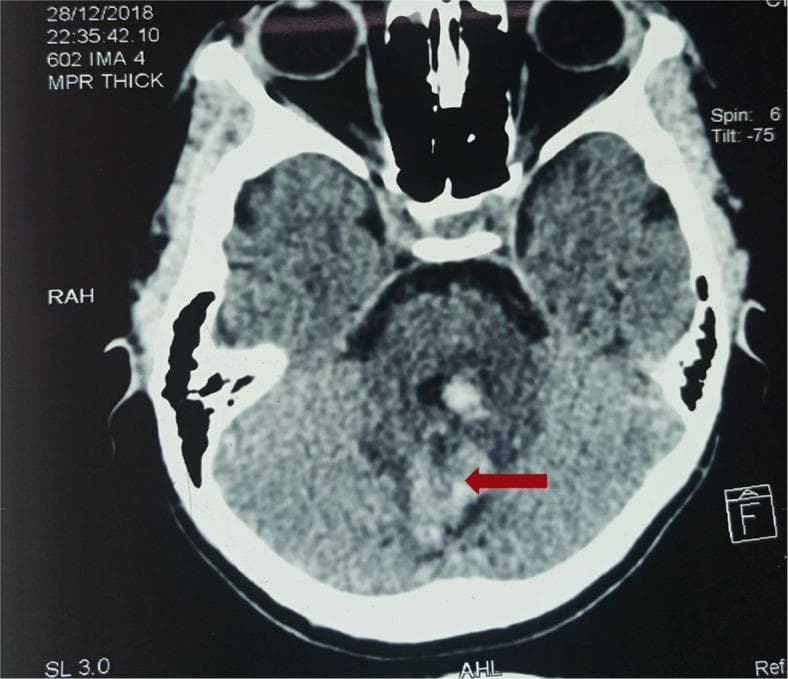 This diagnostic axial CT scan of the brain demonstrates an acute intracranial hemorrhage. The primary finding, indicated by a red arrow, is a well-defined area of hyperdensity within the left cerebellar hemisphere, consistent with an intraparenchymal hematoma. The hyperdense signal indicates acute clotted blood, which shows increased attenuation compared to the surrounding cerebellar parenchyma. A faint rim of hypodensity is visible around the hemorrhage, representing perihematomal edema. Additional hyperdense foci are noted near the midline, possibly involving the cerebellar vermis. Anatomical landmarks such as the temporal lobes, orbits, and bony skull structures are visible, providing spatial orientation. This image serves as an educational example of spontaneous posterior fossa hemorrhage, which in this clinical context is associated with systemic coagulopathy following an elapid or viperid snake bite. It illustrates the role of non-contrast CT in identifying acute hemorrhagic stroke and evaluating for secondary mass effect or brainstem compression.