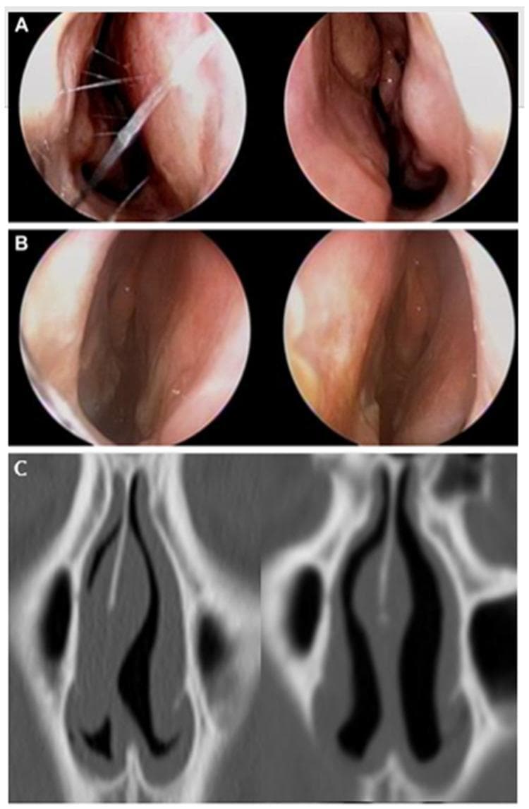 This composite medical image provides a preoperative and postoperative comparison of a nasal septoplasty procedure for correcting a deviated nasal septum. Row A shows preoperative endoscopic views, demonstrating a significant septal deviation and pronounced asymmetry between the bilateral nasal passages, with one side appearing severely narrowed. Visible suture-like structures in the left image likely represent intraoperative markers or temporary stabilizing materials. Row B displays the postoperative endoscopic results, showing a straighter septum and improved symmetry in the nasal airway. Row C presents coronal CT images of the nasal cavity. The preoperative CT scan (left) reveals a marked deviation of the perpendicular plate of the ethmoid (PPE) and upper cartilaginous septum, which encroaches on the internal nasal valve (INV) space. The postoperative CT scan (right) demonstrates the surgical correction, with the nasal septum now centrally aligned, leading to a visible increase in the cross-sectional area and volume of the bilateral nasal passages. This sequence illustrates the anatomical restoration of nasal airflow and airway symmetry.
