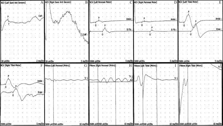 A composite panel of electrodiagnostic waveforms from a nerve conduction study (NCS) and F-wave analysis in a clinical setting. Panels A and B display sensory nerve conduction velocity (NCV) waveforms for the left and right sural nerves, respectively; Panel A shows a defined sensory nerve action potential (SNAP) while Panel B demonstrates significant dispersion and baseline instability. Panels C through F represent motor NCV studies of the left and right peroneal and tibial nerves, showing compound muscle action potentials (CMAPs) with markers for onset (O) and peak (P) at ankle, knee, and fibular head (B Fib) stimulation sites. Panels G through J display late response F-wave studies for the bilateral peroneal and tibial nerves. Notably, Panel G shows an absent or severely diminished F-wave response in the left peroneal nerve, while Panel J shows a highly irregular, high-amplitude waveform in the right tibial nerve. These findings are used to evaluate peripheral neuropathies, demyelinating conditions like Guillain-Barré Syndrome (GBS), or axonal injury.
