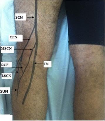 This clinical photograph shows a surface anatomy projection of the sciatic nerve (ScN) and its branches on the posterior aspect of a patient's left knee and leg. The illustration demonstrates the bifurcation of the sciatic nerve into the medial tibial nerve (TN) and the lateral common peroneal nerve (CPN). From the CPN, the lateral sural cutaneous nerve (LSCN) and the fibular communicating branch (RCF) are shown branching off. On the medial side, the medial sural cutaneous nerve (MSCN) descends from the tibial nerve. These branches converge to form the sural nerve (SuN) in the lower leg. The diagram serves as an educational tool for understanding the peripheral nerve distribution in the popliteal fossa and posterior compartment of the leg, specifically highlighting the pathways relevant to conditions like external popliteal sciatic nerve (EPSN) injuries or peripheral nerve tumors.