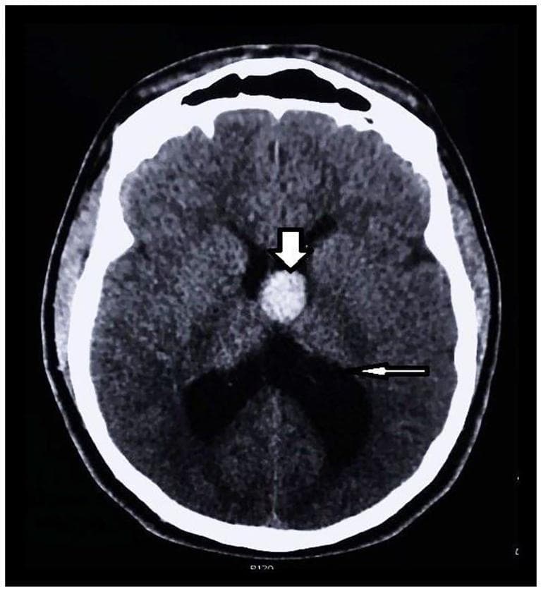 This diagnostic image is an axial non-contrast head CT scan demonstrating a classic presentation of a third ventricle colloid cyst with secondary obstructive hydrocephalus. Centrally located in the region of the foramen of Monro is a well-defined, hyperdense, rounded lesion (indicated by a thick white arrow), characteristic of a proteinaceous colloid cyst. The mass occupies the anterior third ventricle, leading to a significant obstruction of cerebrospinal fluid (CSF) flow. Evidence of resultant obstructive hydrocephalus is seen through the marked enlargement and bowing of the lateral ventricles (indicated by a thin white arrow). The surrounding brain parenchyma shows compression effects due to ventricular dilation. This clinical case illustrates a critical neurosurgical entity where a small, benign-appearing mass can cause life-threatening increases in intracranial pressure due to its strategic anatomical location within the ventricular system.