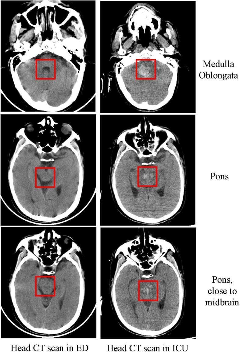 This diagnostic image is a side-by-side comparison of axial non-contrast head CT scans from the emergency department (ED) and the intensive care unit (ICU), illustrating disease progression over a five-day interval. The comparison highlights three brainstem levels: the medulla oblongata, the pons, and the pons near the midbrain transition. In the initial ED scans (left column), the brainstem structures appear relatively normal with homogenous tissue density and preserved anatomy. In contrast, the subsequent ICU scans (right column) demonstrate significant interval changes characterized by new, ill-defined hyperdense areas within the red-boxed regions of interest. These hyperdensities are consistent with acute intracranial hemorrhage (brainstem hemorrhage) involving the medulla oblongata and extending superiorly into the pons. This progression represents a severe complication of encephalitis, such as that caused by Epstein-Barr virus (EBV). The visual evidence serves to teach the radiological manifestations of rapid neurological deterioration and secondary hemorrhagic transformation in the setting of severe central nervous system infection.