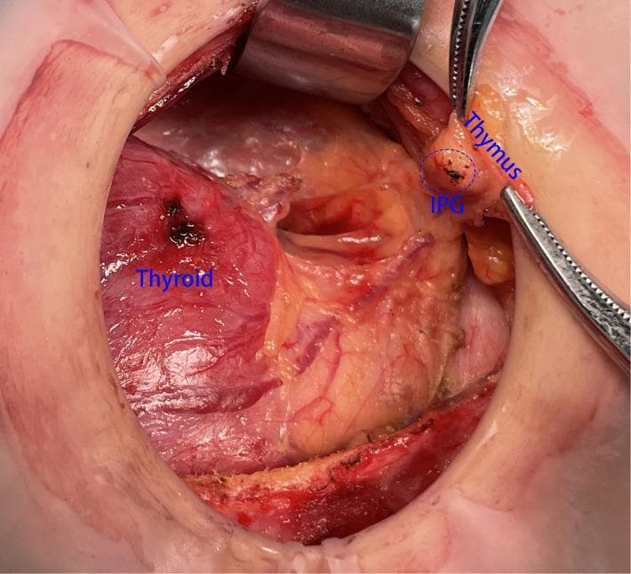 This clinical photograph shows an intraoperative view of a thyroidectomy or neck dissection, highlighting the surgical anatomy of the thyroid gland, thymus, and inferior parathyroid gland (IPG). The thyroid gland is a large, reddish, vascularized structure visible on the left side. Surgical forceps are used to retract the thymus, an elongated, yellowish-tan tissue located superior and lateral to the thyroid. The IPG is visible as a small, distinct ovoid nodule closely associated with the superior aspect of the thymic capsule, circled and labeled in blue. This visual demonstrates the 'in situ reservation' technique, where the IPG and thymus are preserved as an organic unit to maintain parathyroid blood supply during central lymph node dissection. The surgical field displays exposed soft tissue, retractor placement, and visible vasculature, providing educational context for endocrine surgeons and residents regarding the preservation of parathyroid function.